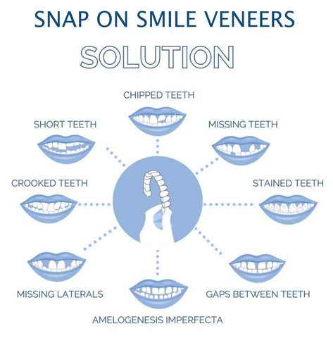 Clip On Cosmetic Veneer Set Upper and Lower